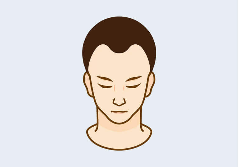 receding hairline