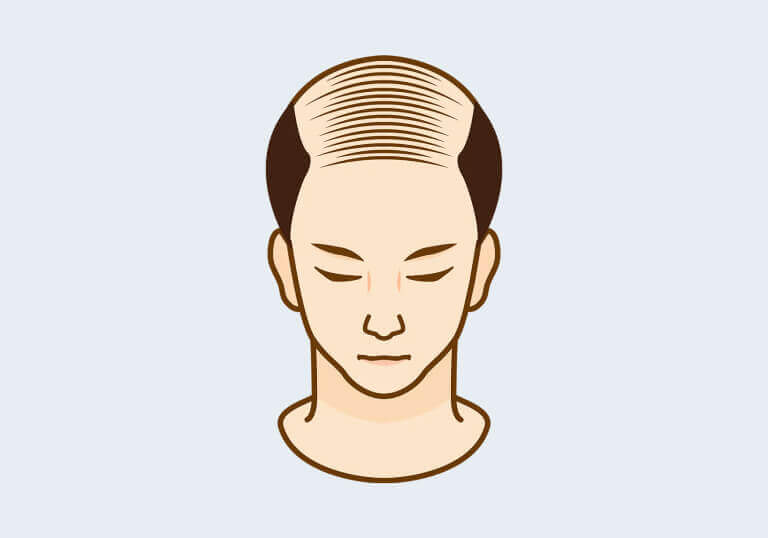 receding hairline thinning
